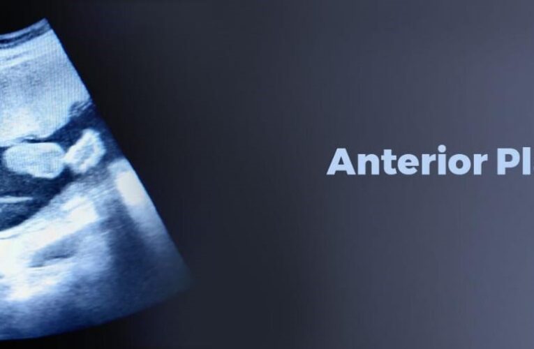 Anterior Placenta: What is the Effect of Placental Position on Pregnancy?